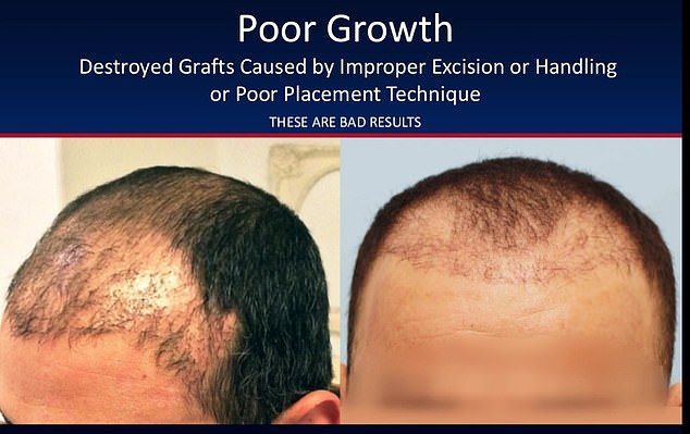 Почему не стоит делать пересадку волос у иностранных «специалистов» МиР