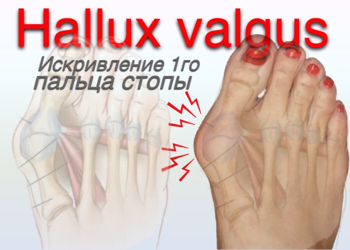 Заболевания пальцев ног болезни