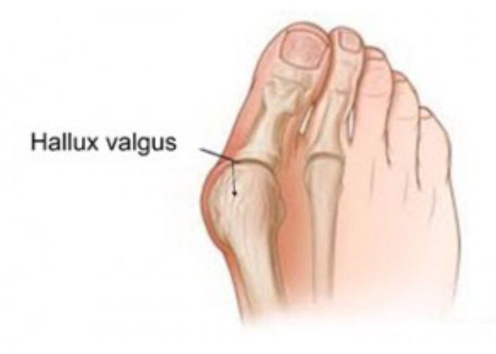 Заболевания пальцев ног болезни