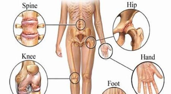 Основні тригери артриту: що категорично не можна їсти