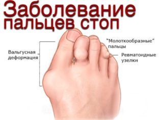 Захворювання пальців ніг