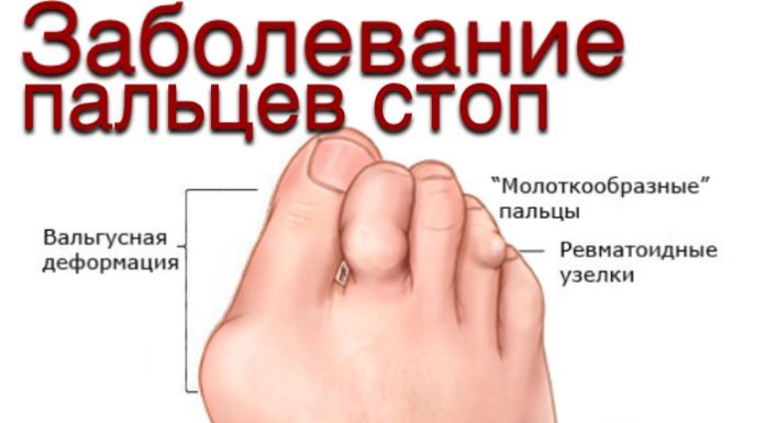 Захворювання пальців ніг