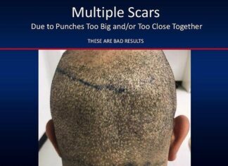 Чому не варто робити пересадку волосся в іноземних спеціалістів