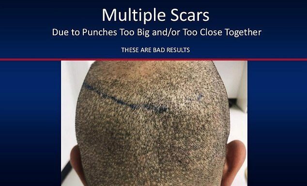 Чому не варто робити пересадку волосся в іноземних спеціалістів