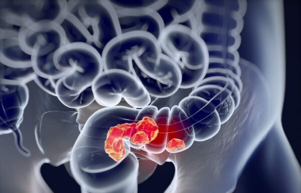 У родичів людей з колоректальним раком ризик розвитку хвороби вище в 6 разів