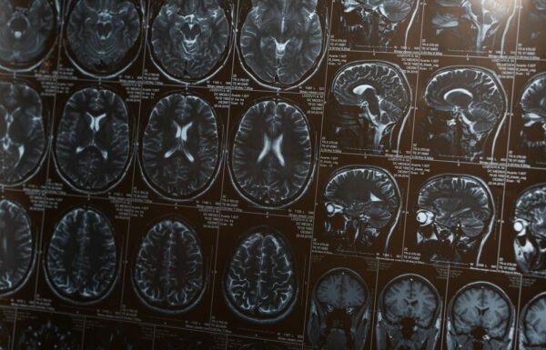 Петиція в моз. Деменцію попросили не вважати психічним захворюванням