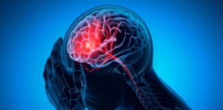 Un farmaco per l’ictus che in realtà non provoca sanguinamento?
